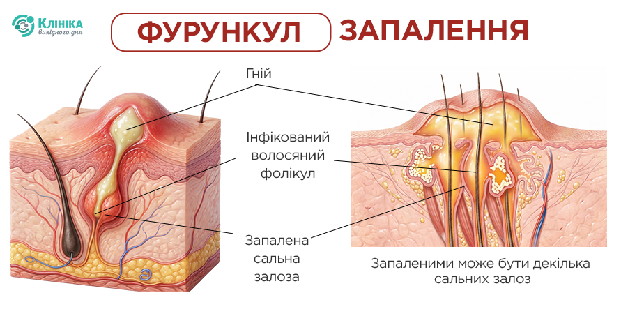 Pic4_фурункул_укр.jpg
