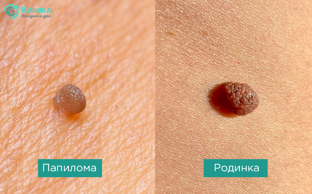 папилома родинка.jpg