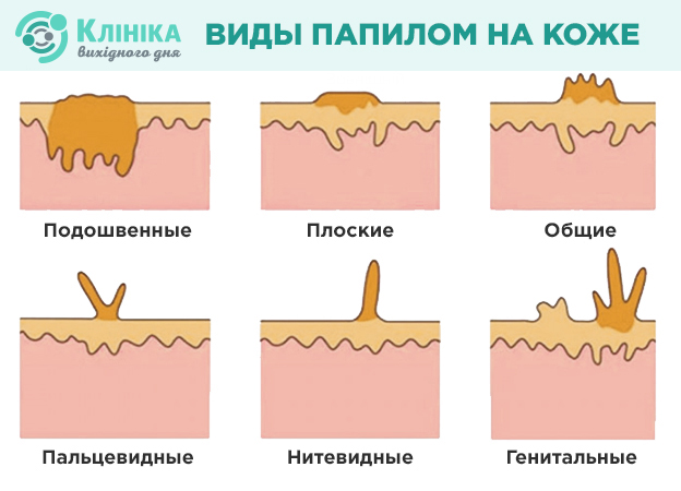 папиломы.jpg