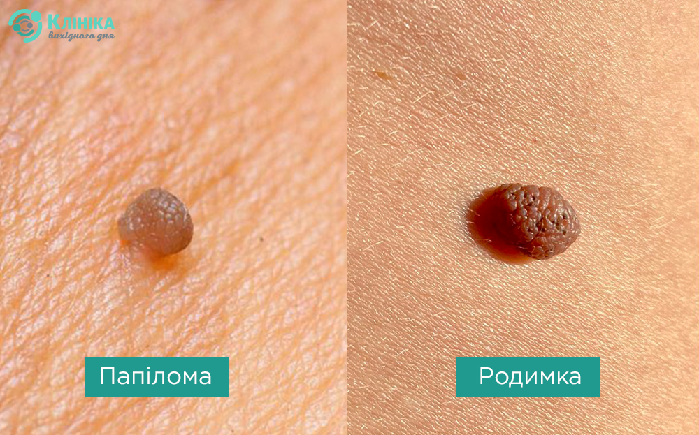 папілома родимка.jpg