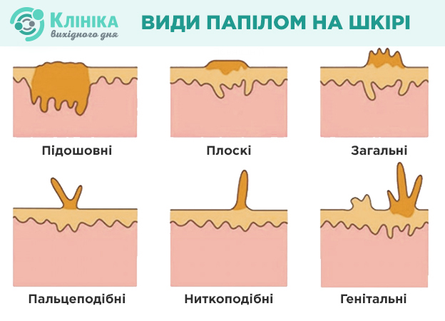папіломи.jpg