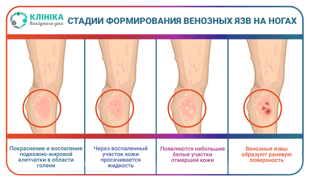 варикоз стадии.jpg