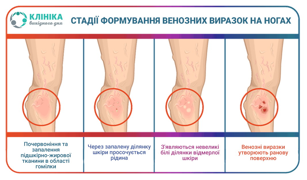 варикоз стадії.jpg
