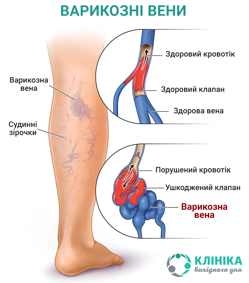 що таке варикоз.jpg