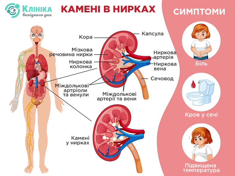 камені симптоми.jpg
