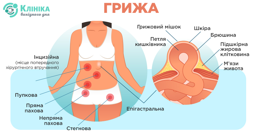 Vydy pahovoyi hryzhi.jpg