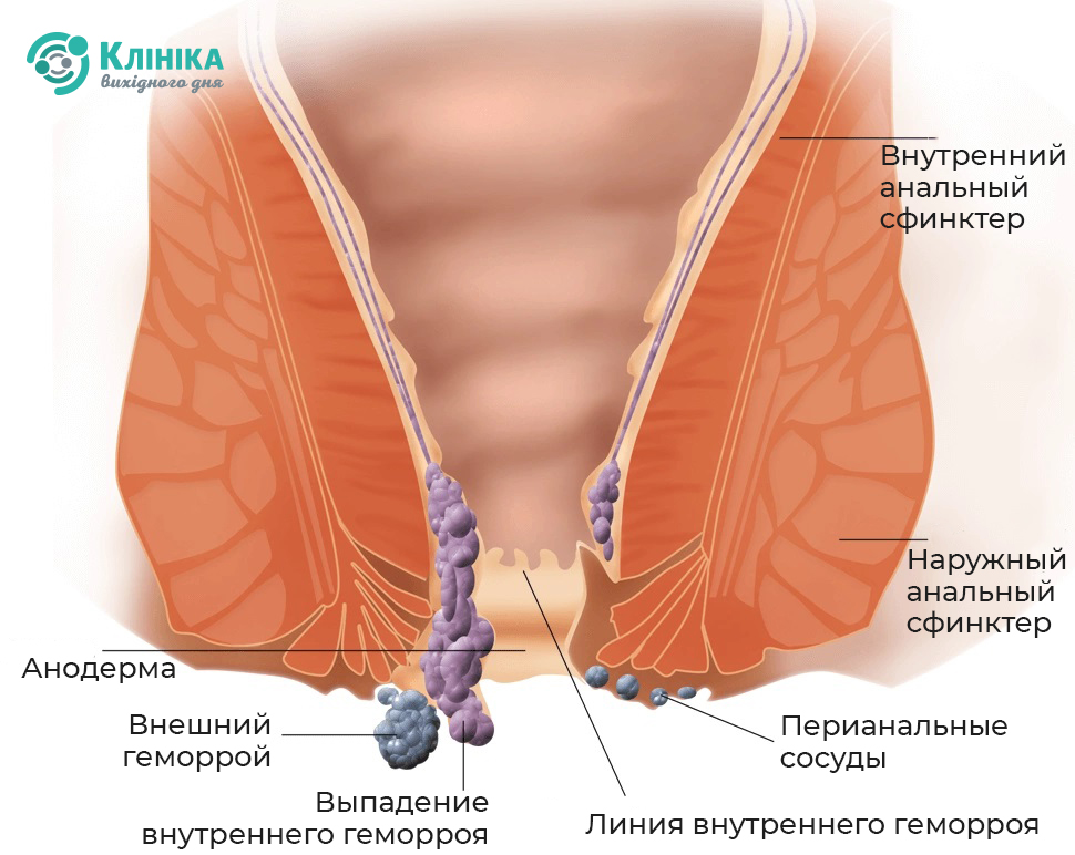 Hemorrhoid_ру.jpg