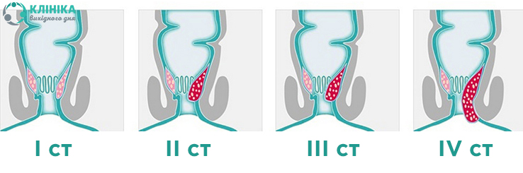 Pic_Геморроидектомия1 (2).jpg