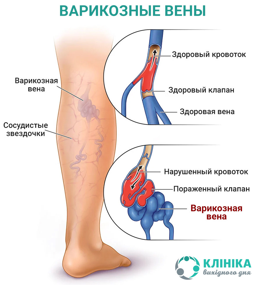 Варикозные вены