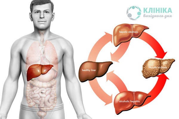 Алкогольний цироз печінки