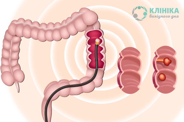 Все, що потрібно знати про колоноскопію
