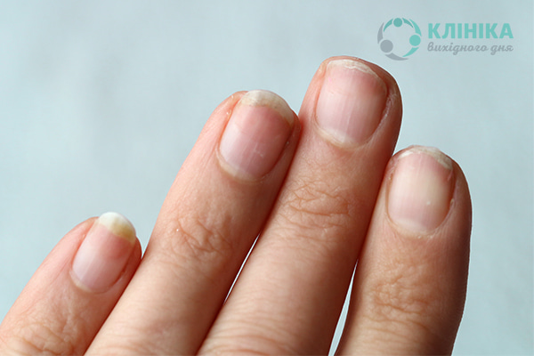 Проблемы с ногтями: признаки, которые нельзя недооценивать