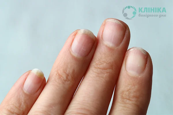 Как укрепить хрупкие и слоящиеся ногти?