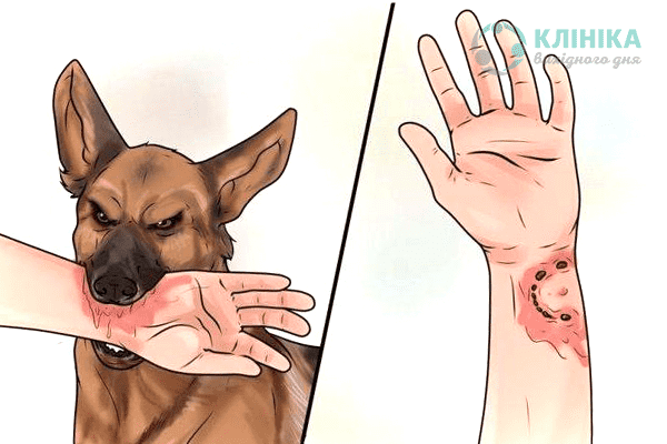 Що робити при укусі собаки?