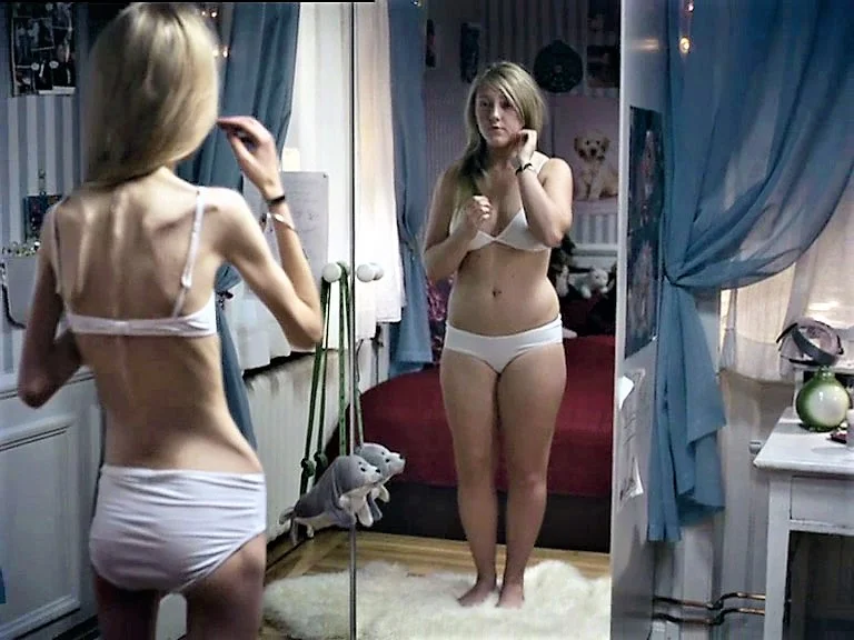 Во время и после анорексии: 10 фотографий людей, которым удалось выжить