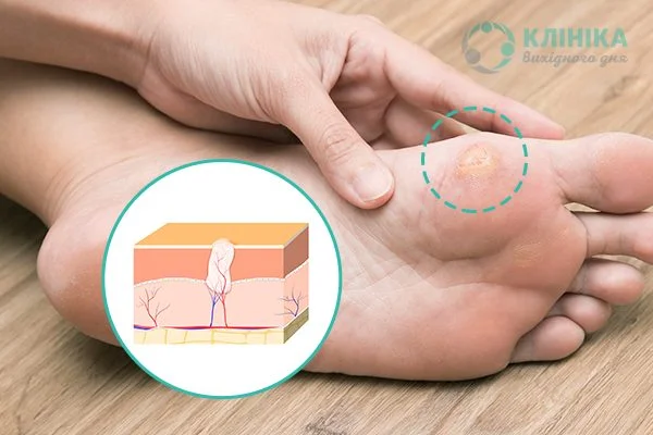Стержневая мозоль на пальце и мизинце ноги: как избавиться, лечение, мази, фото