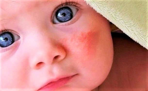 Алергічний діатез у дитини!