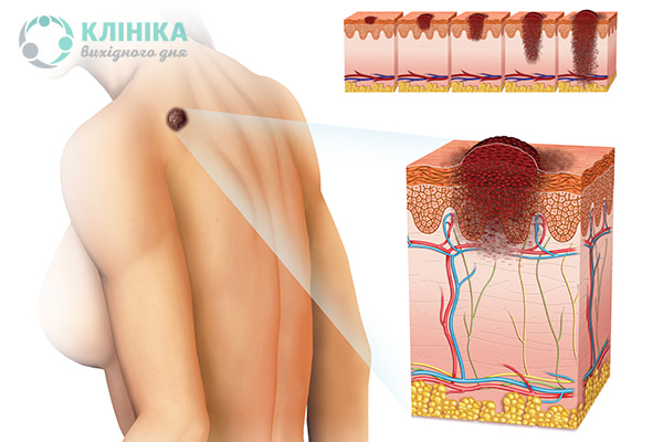 Меланома - симптомы, причины, диагностика и лечение в лучших клиниках - MedTour