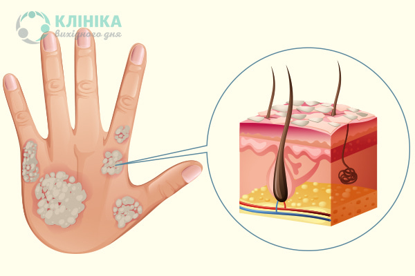 Псориаз кожи головы, ногтей и суставов: симптомы, лечение | Клиника Рассвет