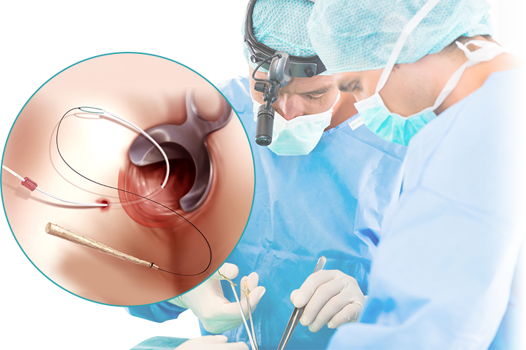 Висічення анальної нориці: операція, післяопераційний період, відновлення