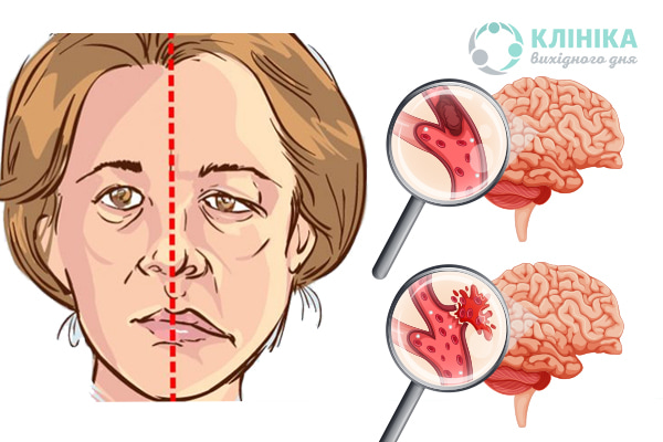 Інсульт та його наслідки