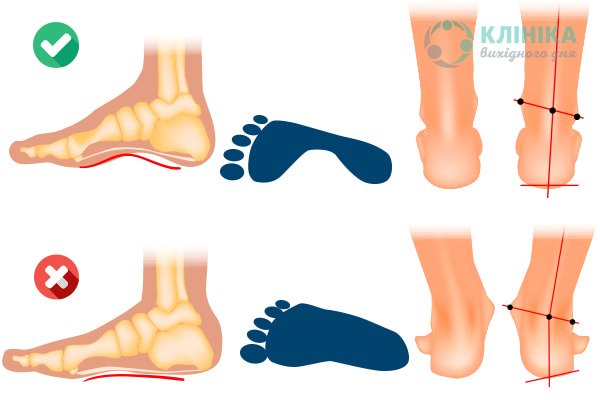 Вальгусна деформація стоп