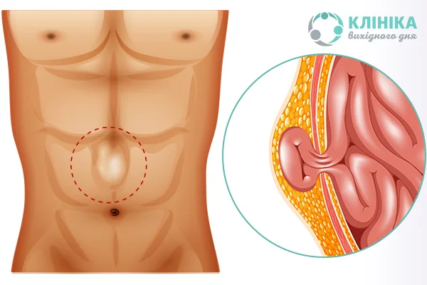 Пахвинна грижа: симптоми, види та ефективне лікування у чоловіків та жінок