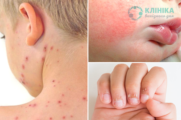  Дитячий дерматолог: з якими захворюваннями шкіри у дитини до нього звернутися?