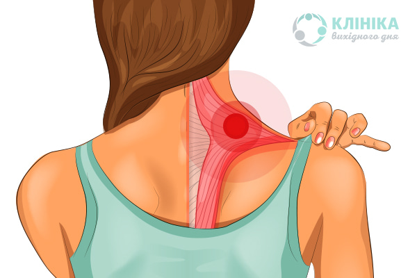 Міозит – чому запалюються м'язи?
