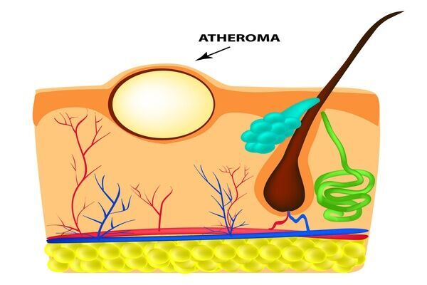Що таке атерома голови і чи потрібно її видаляти?