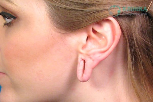 Пластика мочки вуха і видалення шрамів