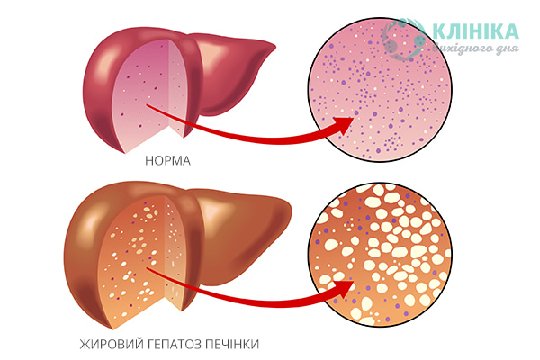 Жировий гепатоз печінки