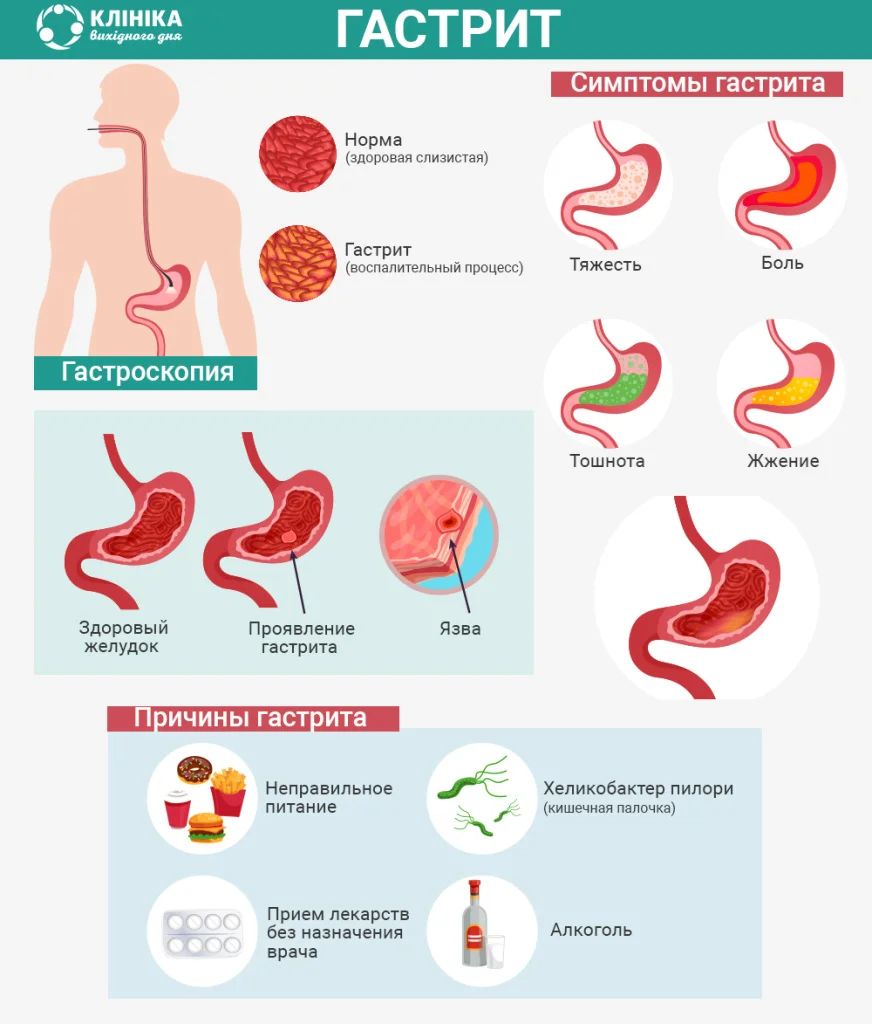 Гастроскопия желудка, ФГДС, глотание зонда (Киев) ᐉ Узнать цену - Клиника  Выходного Дня