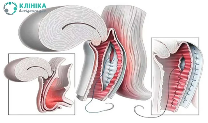 Леваторопластика и кольпоррафия цена - передняя, задняя в КДС Клиник