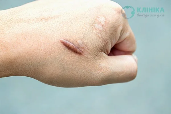 Лечение рубцов и шрамов