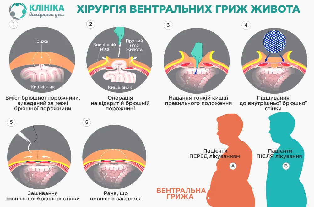 Пахвинна грижа у чоловіків і жінок: ознаки, коса, пряма, ніж небезпечна, який лікар, лікування та операція