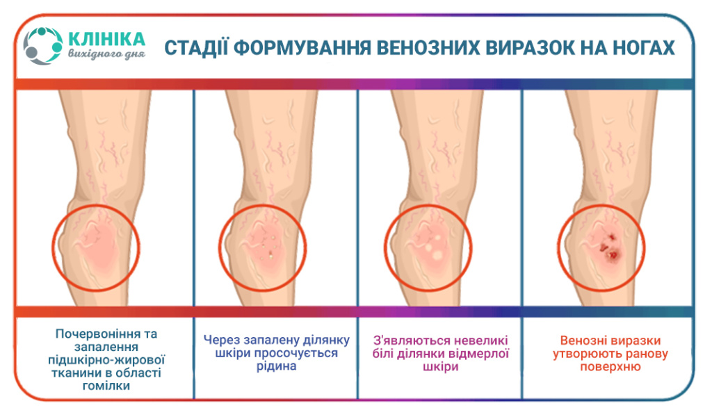 Vascular-Ulcer_ukr.jpg