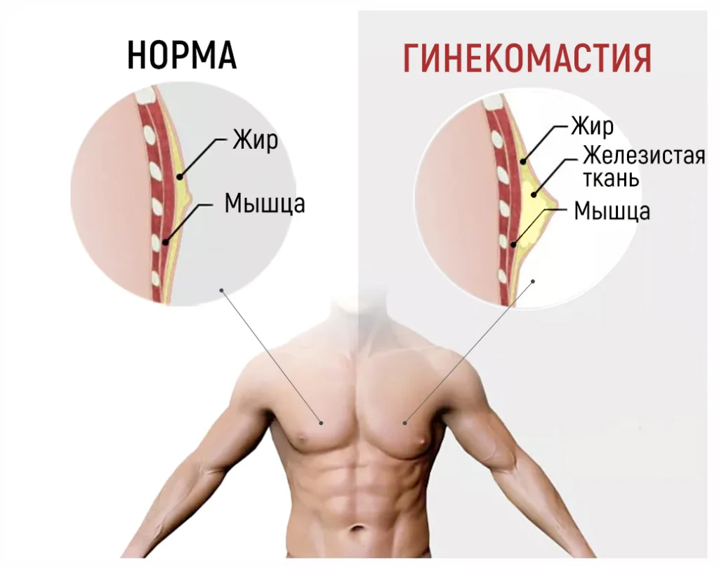 Гинекомастия: Лечение, Операция по удалению, маммология для мужчин ᐉ Цена в Киеве | Клиника выходного дня