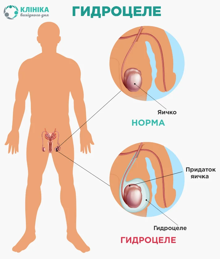 Водянка яичка (гидроцеле): причины, симптомы, диагностика и лечение — Клиника «Доктор рядом»