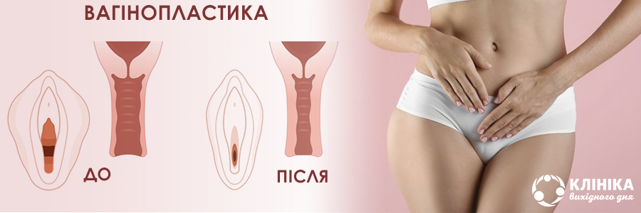 Vaginoplastika_ukr.jpg