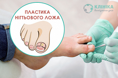 Крайова резекція нігтьової пластини при врослому нігті (оніхокриптозі) 