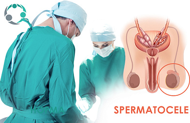 Оперативне лікування кіст придатків яєчок або сперматоцеле