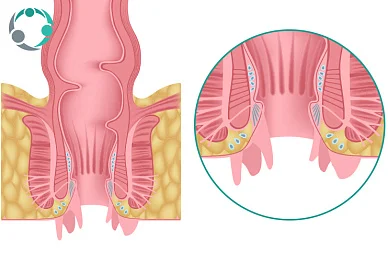 Анальный зуд