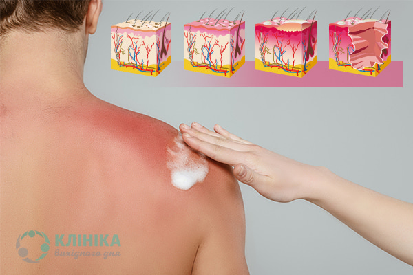Як допомогти шкірі після сонячного опіку?