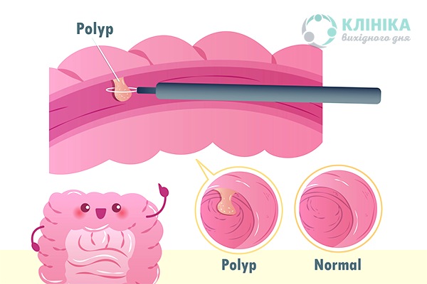 Процедура поліпектомії кишечника