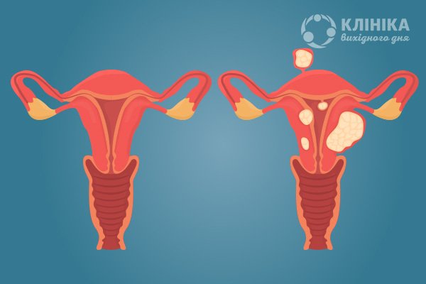Що таке міома матки – симптоми, причини появи, лікування